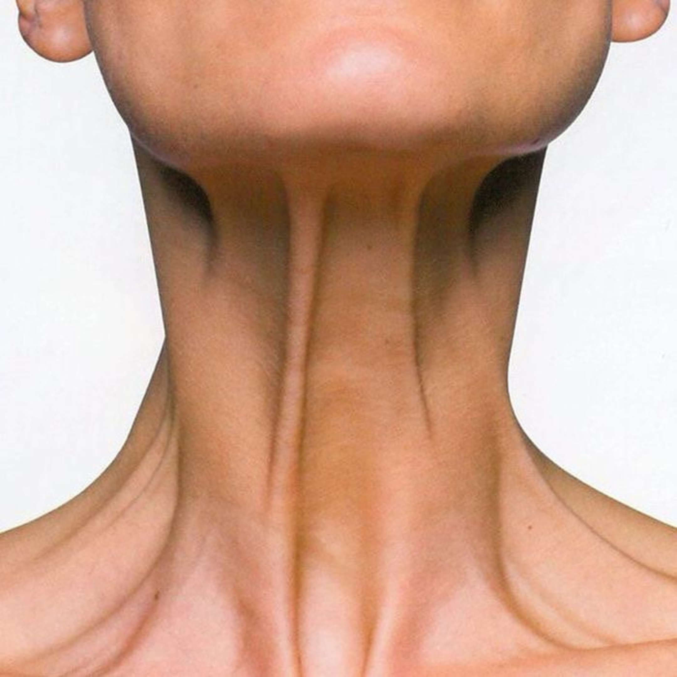 Botox or Filler? Different Treatments, Different Jobs.