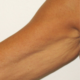 Radiofrequency Skin Tightening