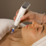 Dermapen DP4 microneedling treatment on face to improve skin texture, tone, and collagen production