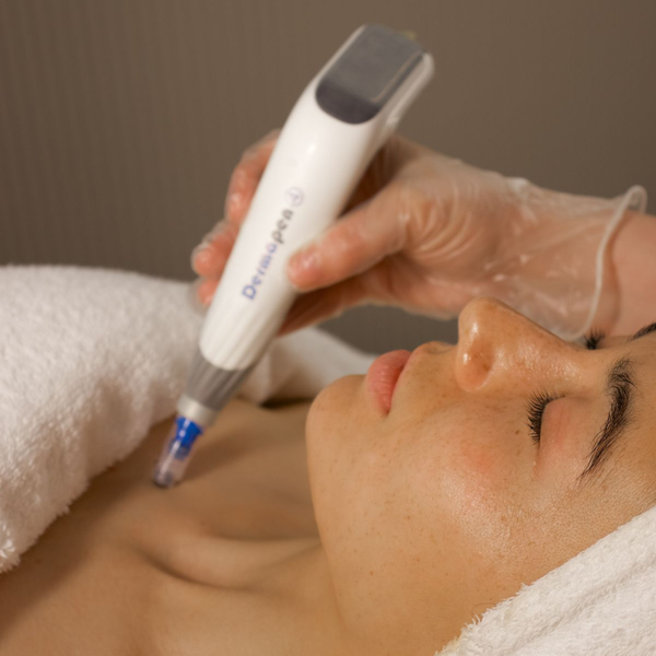 Dermapen DP4 microneedling treatment on face to improve skin texture, tone, and collagen production